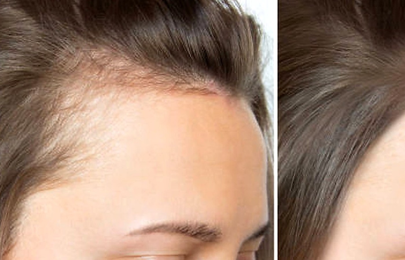 Hair Growth